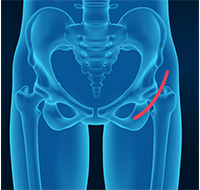 Outpatient Total Hip Replacement